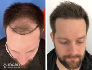 FUE Haartransplantation Vorher Nachher Türkei