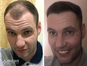 Hair Transplant in Turkey Before After 23