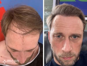 FUE Haartransplantation Vorher Nachher 3