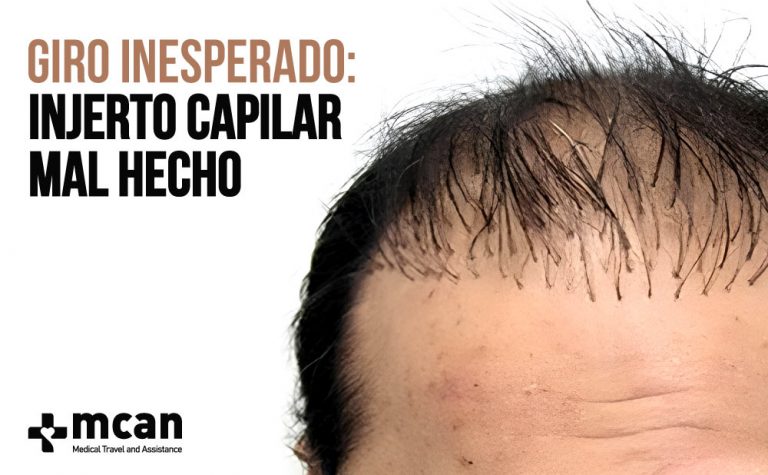 Giro Inesperado: Injerto Capilar Mal Hecho 8 Injerto Capilar Mal Hecho web 1 Injerto Capilar Mal Hecho web 1