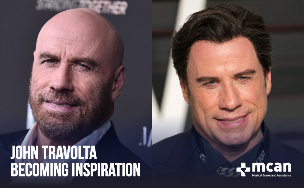 John Travolta Hair Transplant