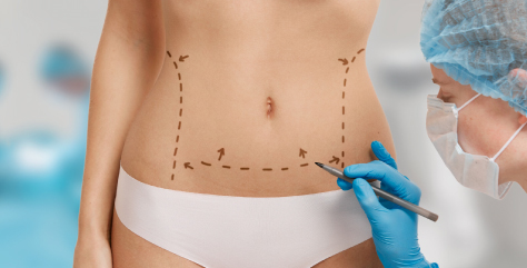 Tummy Tuck