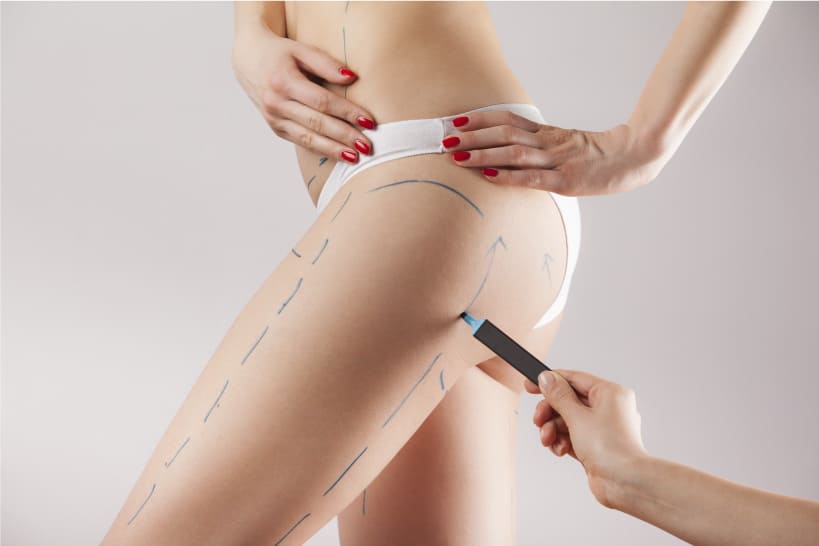 Thigh Lift London, Thigh Reduction Surgery UK