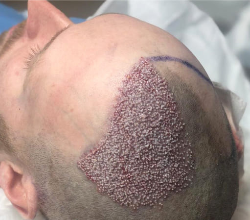 Подкожная пересадка волос в Турции 15 best candidates for dhi hairtransplant DHI Haartransplantation in der Türkei bei MCAN Health