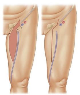 Lifting de Muslos Internos (Lifting de Muslo Medial)