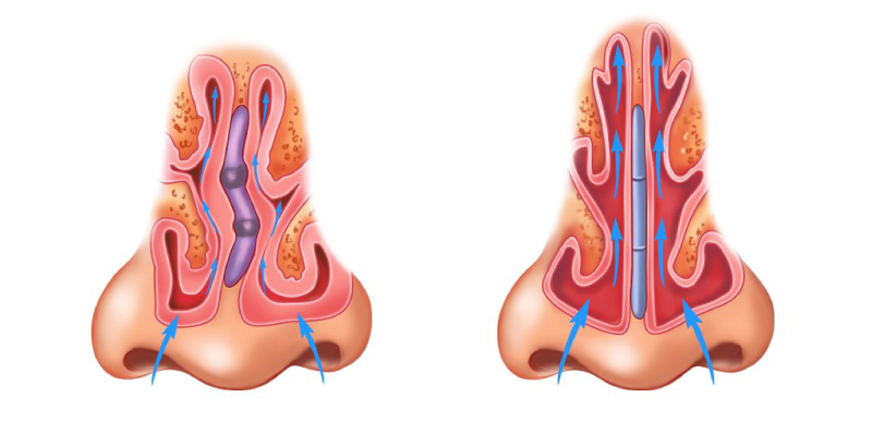 rinoplastia 