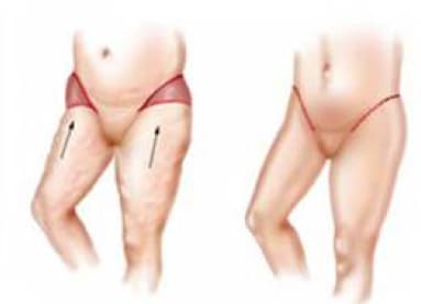 Outer Thigh Lift (Lateral Thigh Lift)