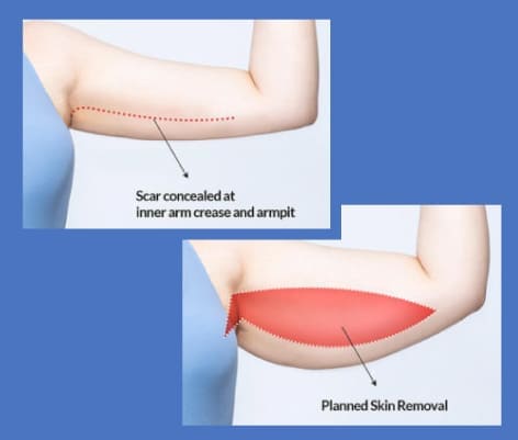 Braquioplastia Tradicional: