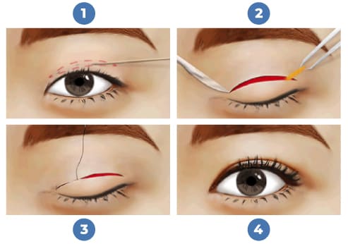 Double Eyelid Surgery