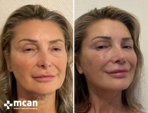 FACELIFT BEFORE AFTER0