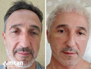 FACELIFT BEFORE AFTER2