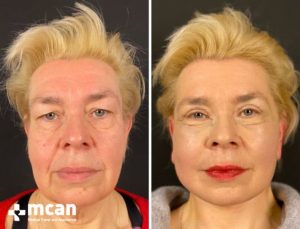 FACELIFT BEFORE AFTER3