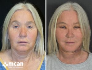 FACELIFT BEFORE AFTER7