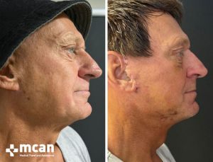 FACELIFT BEFORE AFTER9