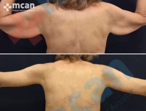 remarkable results after arm lift surgery in Turkey