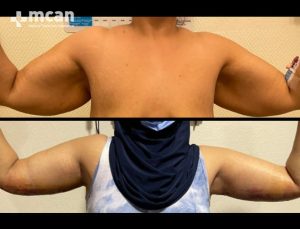 arm lift in turkey before and after