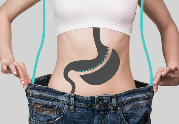 Sleeve Gastrectomie Turquie 32 GOOD CANDIDATE 2 good candidate for gastric sleeve turkey