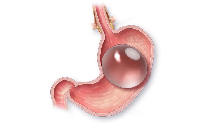 Gastric Balloon