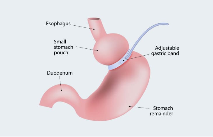 Gastric Band Surgery