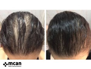 Haartransplantation Frauen Turkei Ergebnisse