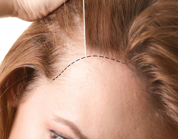 Haartransplantation bei Frauen in der Türkei