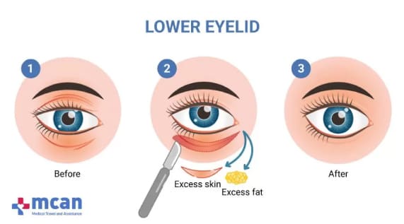 Chirurgie der unteren Augenlider