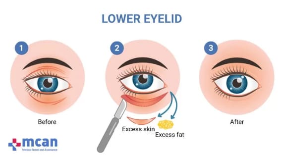 Blefaroplastia Inferior en Turquía
