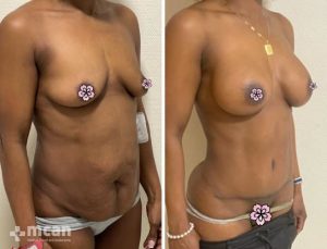 body tranformation through mommy makeover