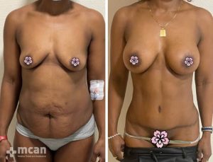 excess skin and fat removed through mommy makeover