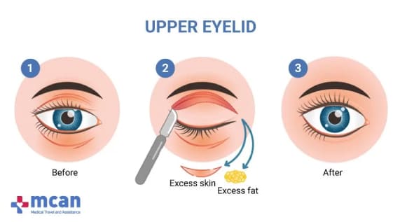 Blépharoplastie Turquie 8 UPPER EYELID Blépharoplastie supérieure en Turquie