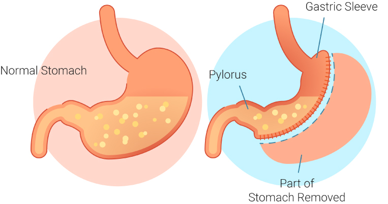 Sleeve Gastrectomie Turquie 1 WHAT IS 2 gastric sleeve turkey