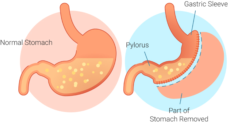 gastric sleeve turkey