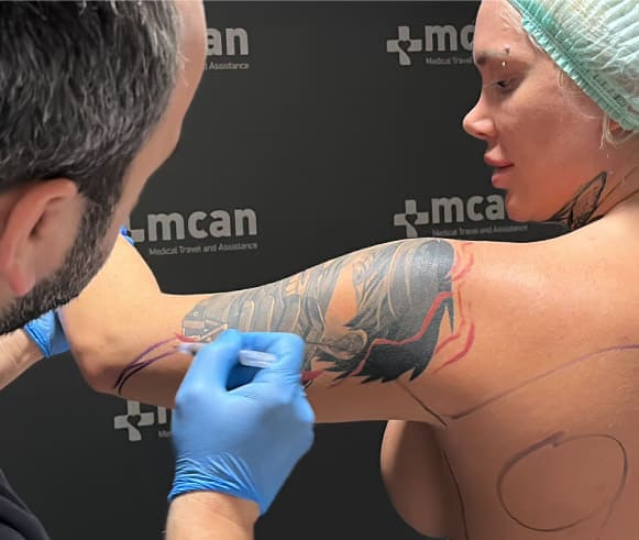 arm lift surgery in Turkey at MCAN