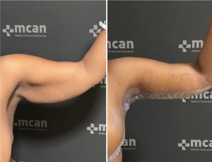 lifting de brazos fotos antes y después