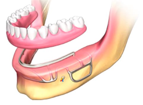 Subperiostale Implantate