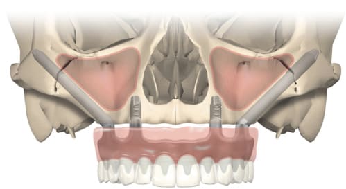 Jochbein-Implantate