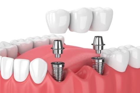 Implantatgetragene Brücken