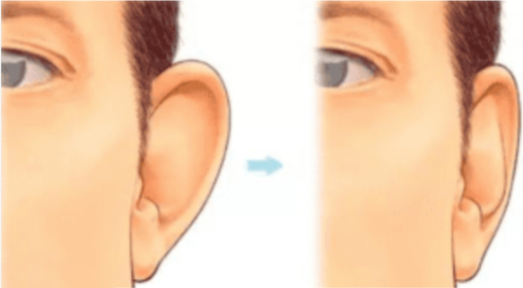 Ear Reduction