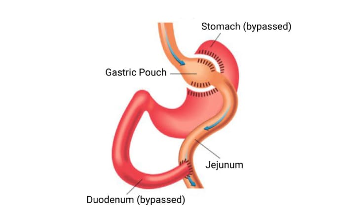 Gastric Bypass