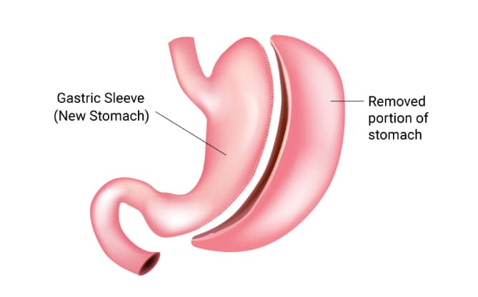 Gastric Sleeve Surgery