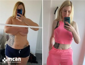 gastric sleeve in turkey before and after