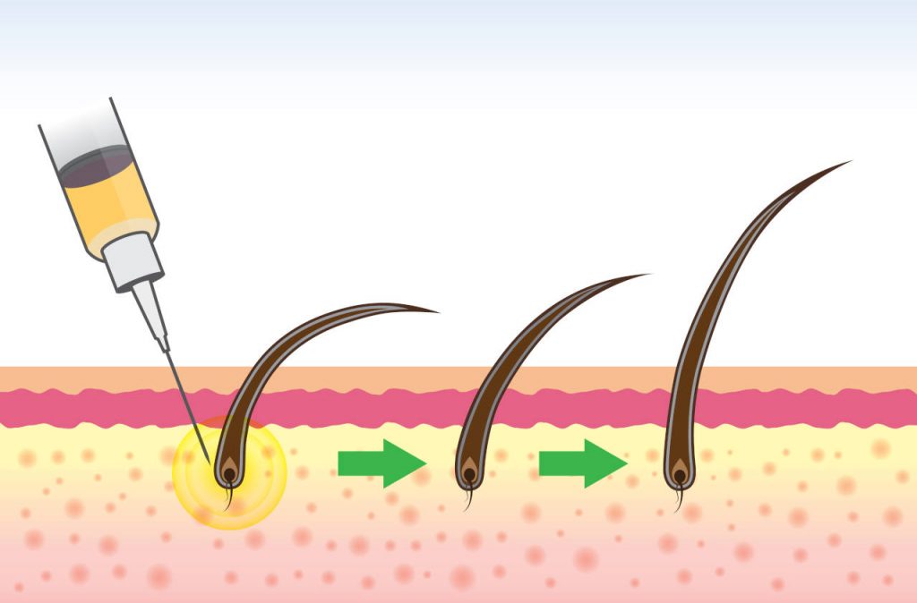 What Is Stem Cell? How Can It Be Beneficial for Treating Hair Loss? 4 Hair follicle treatment where stem cells are injected into the scalp hair loss therapy