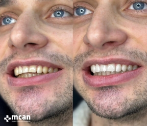 Белоснежные зубы благодаря отбеливанию зубов в Турции