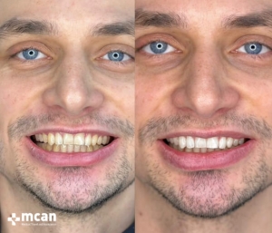 До и после отбеливания зубов в Турции