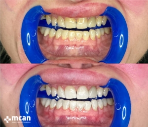 Обновленная ослепительная улыбка в результате отбеливания зубов в Турции