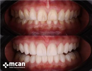 Zahn Veneers Vorher Nachher Turkei, Istanbul