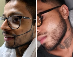 Фото до и после пересадки бороды в Турции
