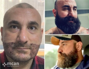 Результаты лучшей пересадки бороды в Турции