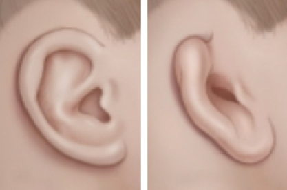 Ohrvergrößerung (Otoplastik bei unterentwickelten Ohren)