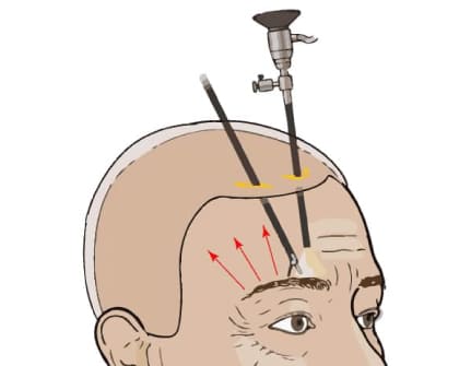 Lifting Endoscopico de Cejas: